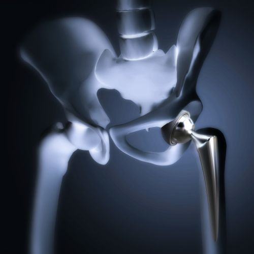 Robotic Hip Replacement Technology