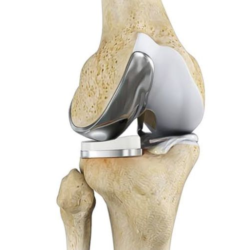 Partial Knee Replacement Benefits