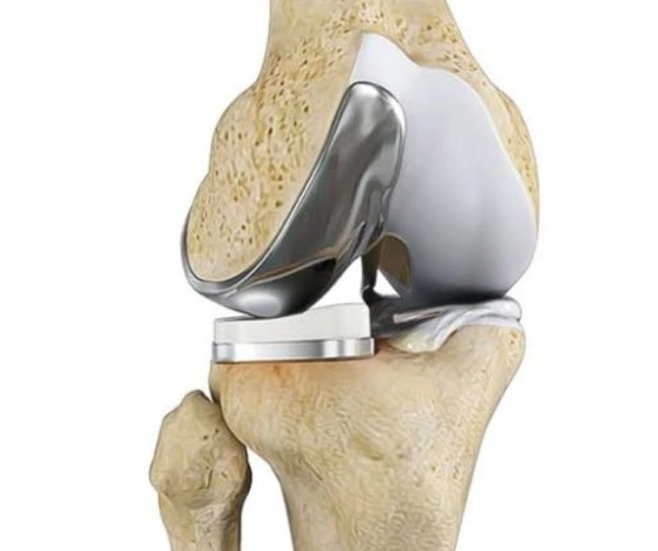 Partial knee replacement surgery