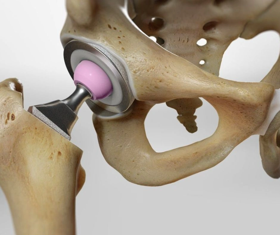 Robotic hip replacement surgery