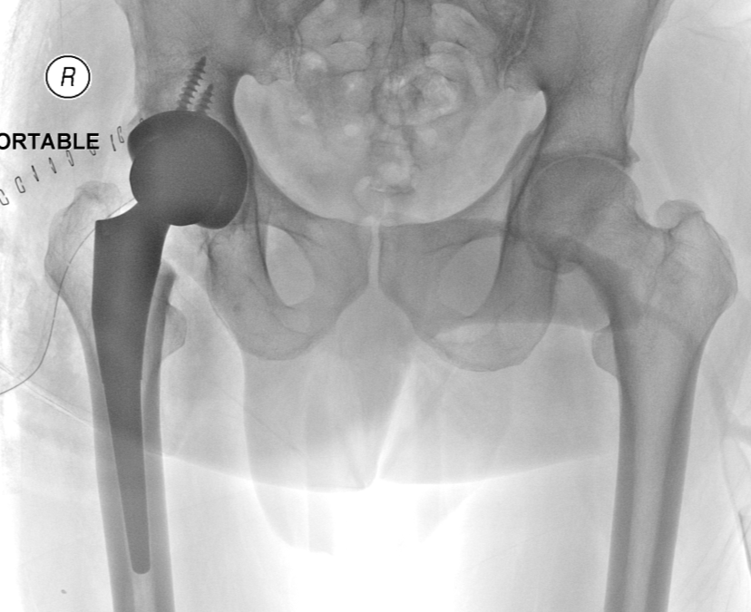 Hip Replacement