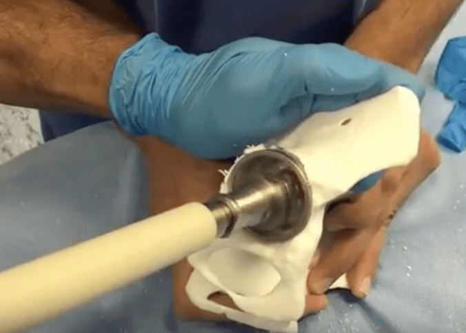 3D printing Orthopaedics